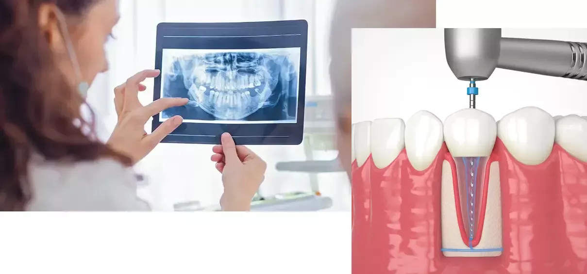 Dental x-ray and illustration of endodontic procedure