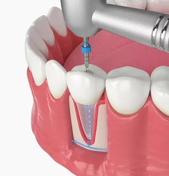 Illustration of an endodontic procedure