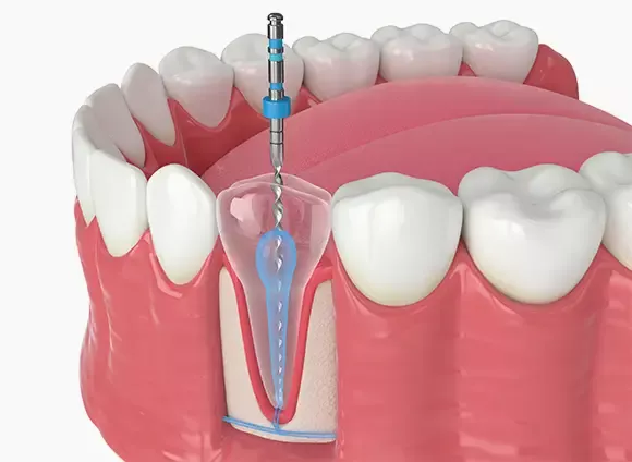 Illustration of an endodontic procedure