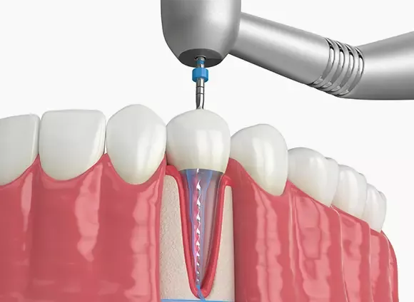 Rendering of root canal procedure