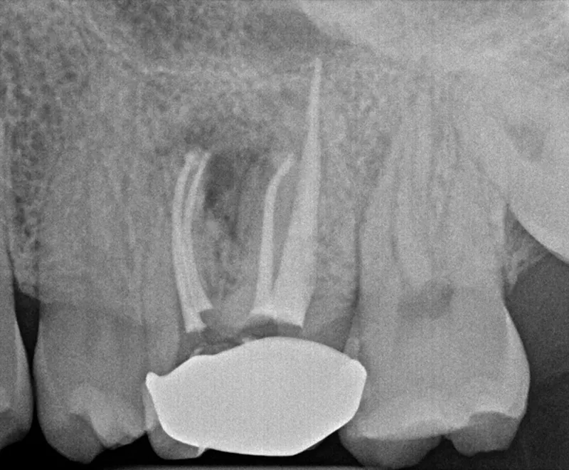 Root canal retreatment after