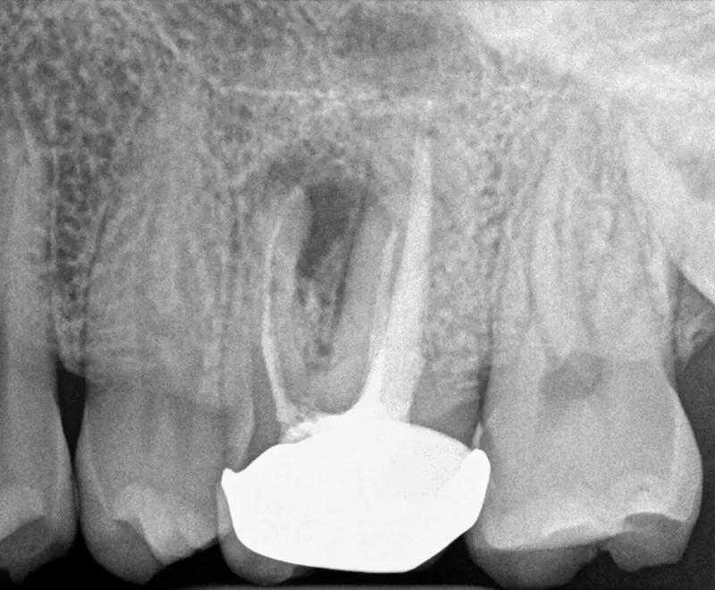 Root canal retreatment before