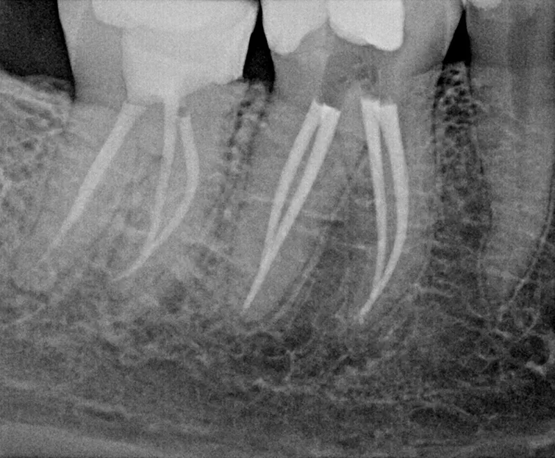 Root canal after