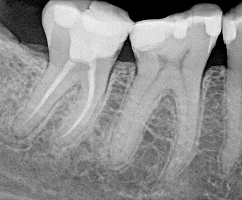 Root canal before